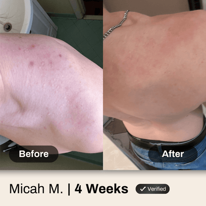 Body Acne System