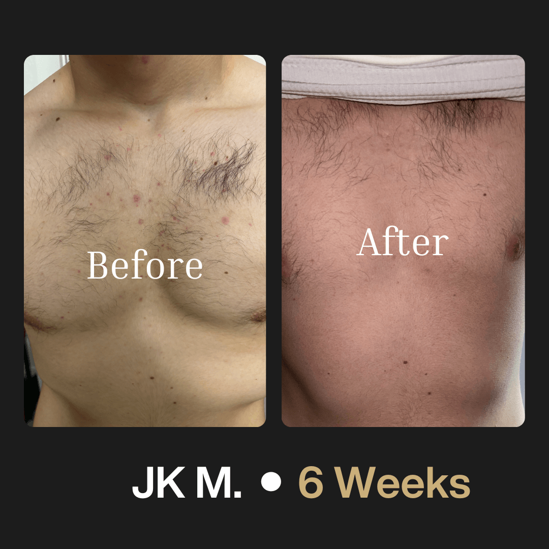 Body Acne System