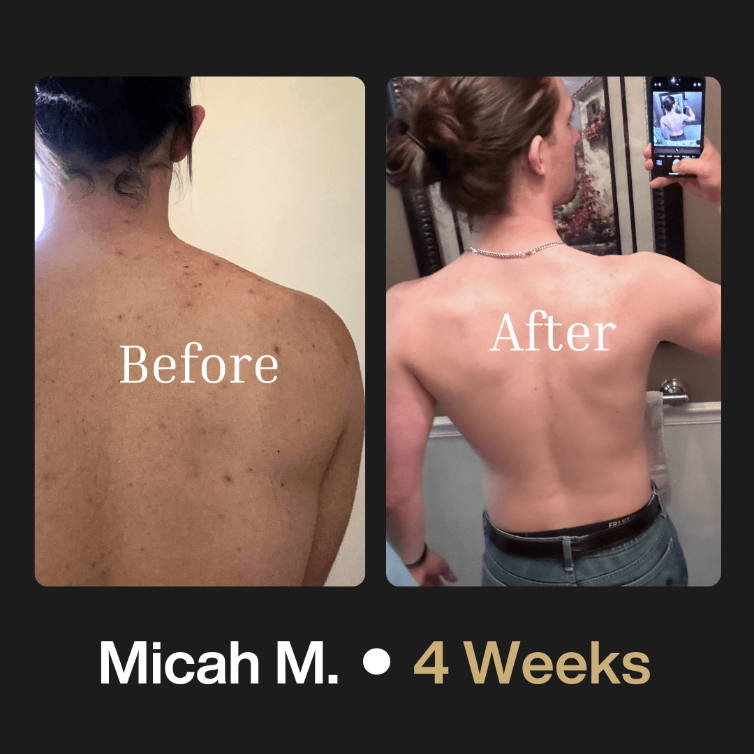 Body Acne System