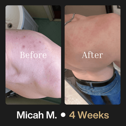 Maximum Strength Body Acne Wash